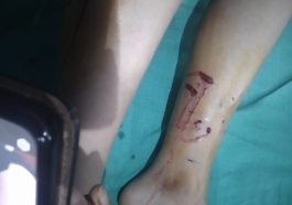 Paonta Sahib News: पालतू कुत्ते ने 10 साल की बच्ची को किया जख्मी