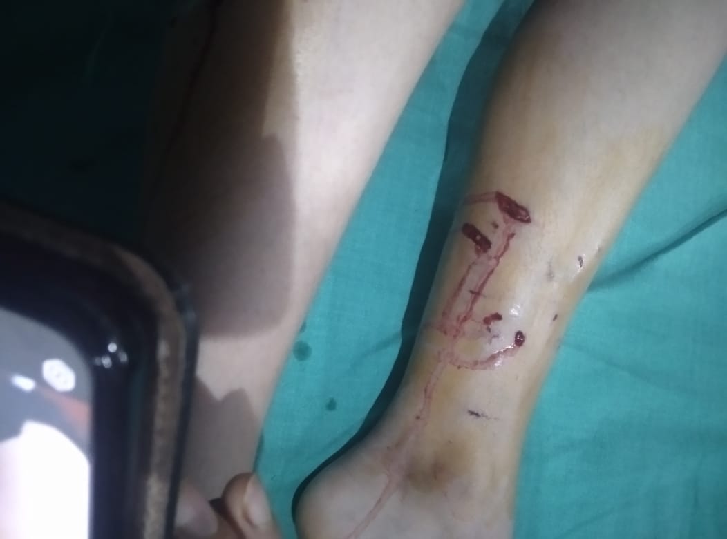 Paonta Sahib News: पालतू कुत्ते ने 10 साल की बच्ची को किया जख्मी