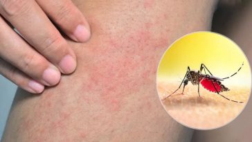 दुखद: हिमाचल की 24 वर्षीय युवती की डेंगू के चलते मौत! पीजीआई चंडीगढ़ में तोड़ा दम