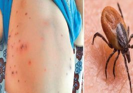 Scrub Typhus: डेंगू के बाद स्क्रब टाइफस ने डराए लोग! सामने आए 22 से अधिक मामले