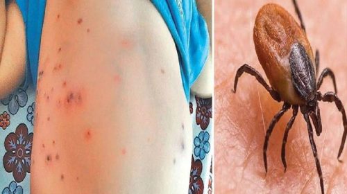 Scrub Typhus: डेंगू के बाद स्क्रब टाइफस ने डराए लोग! सामने आए 22 से अधिक मामले