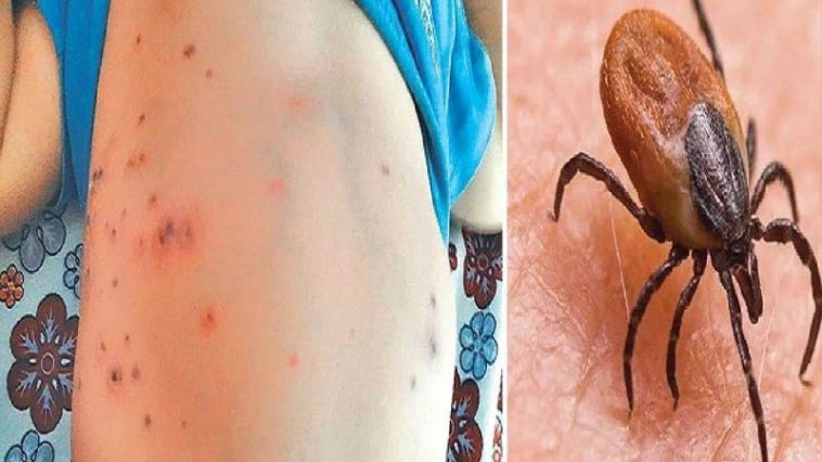 Scrub Typhus: स्क्रब टायफस को लेकर एडवाइजरी जारी! ये लक्षण दिखें तो न करें नजरअंदाज, तुरंत जाएं डॉक्टर के पास