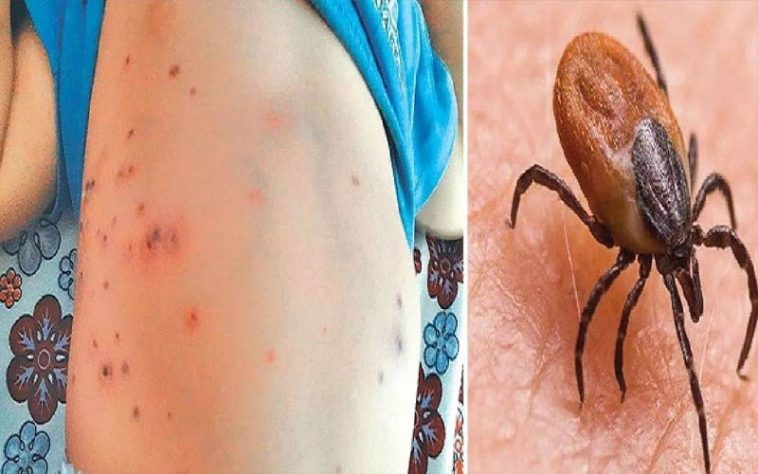 Scrub Typhus: डेंगू के बाद स्क्रब टाइफस ने डराए लोग! सामने आए 22 से अधिक मामले