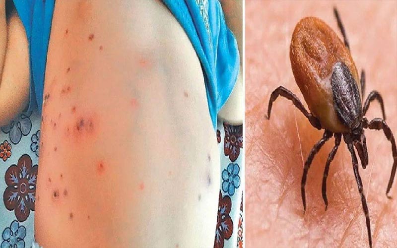 Scrub Typhus: स्क्रब टायफस को लेकर एडवाइजरी जारी! ये लक्षण दिखें तो न करें नजरअंदाज, तुरंत जाएं डॉक्टर के पास