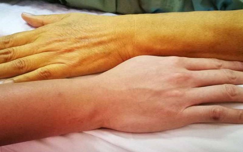 दुखद: हिमाचल के इस जिला में पीलिया फैलने से दहशत! 28 साल के युवक की मौत, प्रतियोगी परीक्षाओं की तैयारी कर रहा था उदित