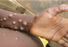 Monkeypox: मंकीपॉक्स को लेकर अलर्ट जारी! डब्ल्यूएचओ ने की ग्लोबल हेल्थ इमरजेंसी की घोषित