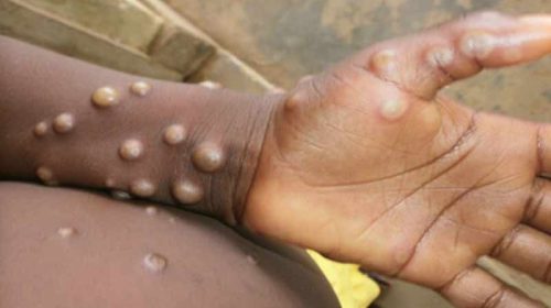 MonkeyPox Alert: हिमाचल में मंकीपॉक्स को लेकर अलर्ट! इन लोगों पर नजर रखेगा स्वास्थ्य विभाग