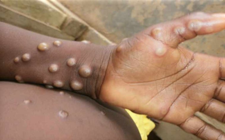 Monkeypox: मंकीपॉक्स को लेकर अलर्ट जारी! डब्ल्यूएचओ ने की ग्लोबल हेल्थ इमरजेंसी की घोषित