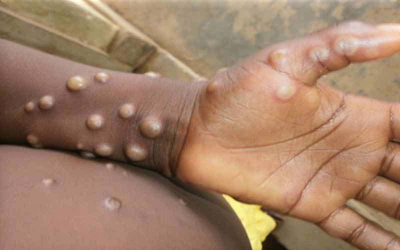 Monkeypox: मंकीपॉक्स को लेकर अलर्ट जारी! डब्ल्यूएचओ ने की ग्लोबल हेल्थ इमरजेंसी की घोषित