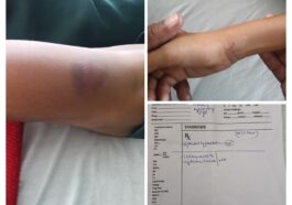 अम्बोया (सिरमौर) : 9वीं के छात्र की शिक्षक ने की बेरहमी से पिटाई, पिता ने की सख्त कार्रवाई की मांग