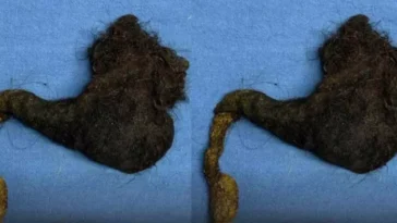 हिमाचल प्रदेश : महिला के पेट से निकला 1 फुट लंबा बालों का गुच्छा, सालों से खा रही थी अपने ही बाल