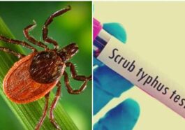 HP News: सिविल अस्पतालों, सीएचसी और पीएचसी में भी अब स्क्रब टायफस सहित टाइफाइड के टेस्ट होंगे निःशुल्क