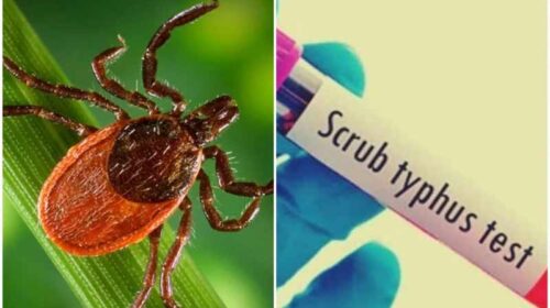 HP News: सिविल अस्पतालों, सीएचसी और पीएचसी में भी अब स्क्रब टायफस सहित टाइफाइड के टेस्ट होंगे निःशुल्क
