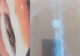 Himachal News: AIMSS चमियाना के डॉक्टरों का कमाल! फूड-पाइप में फंसे सिक्के को निकाला, युवती ने 15 साल पहले निगला था