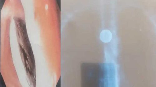 Himachal News: AIMSS चमियाना के डॉक्टरों का कमाल! फूड-पाइप में फंसे सिक्के को निकाला, युवती ने 15 साल पहले निगला था Himachal News: AIMSS चमियाना के डॉक्टरों का कमाल! फूड-पाइप में फंसे सिक्के को निकाला, युवती ने 15 साल पहले निगला था