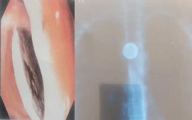 Himachal News: AIMSS चमियाना के डॉक्टरों का कमाल! फूड-पाइप में फंसे सिक्के को निकाला, युवती ने 15 साल पहले निगला था Himachal News: AIMSS चमियाना के डॉक्टरों का कमाल! फूड-पाइप में फंसे सिक्के को निकाला, युवती ने 15 साल पहले निगला था