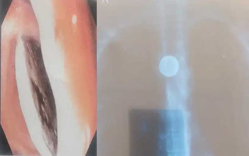 Himachal News: AIMSS चमियाना के डॉक्टरों का कमाल! फूड-पाइप में फंसे सिक्के को निकाला, युवती ने 15 साल पहले निगला था