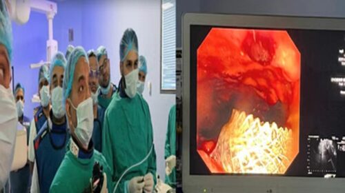 उपलिब्ध: चमियाना अस्पताल के डॉक्टरों का कमाल! EUS सिस्टोगैस्ट्रोस्टोमी का किया उपयोग, मरीजों को बड़ी सुविधा