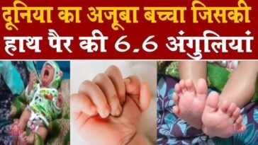 हिमाचल में 24 उंगलियों वाले बच्चे का जन्म, चारों हाथ-पैरों में दिखी अनोखी बनावट