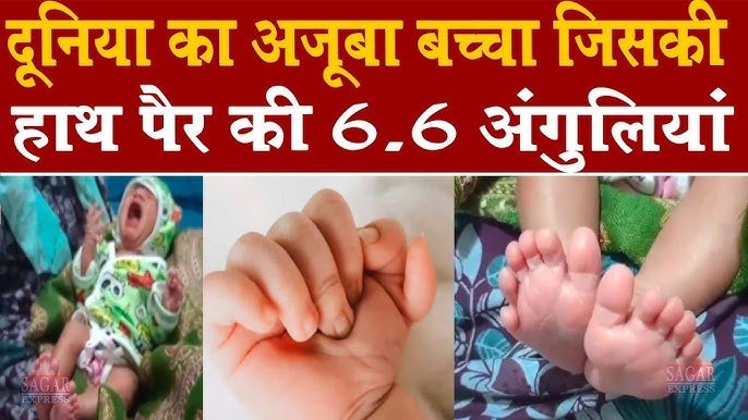हिमाचल में 24 उंगलियों वाले बच्चे का जन्म, चारों हाथ-पैरों में दिखी अनोखी बनावट हिमाचल में 24 उंगलियों वाले बच्चे का जन्म, चारों हाथ-पैरों में दिखी अनोखी बनावट
