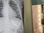 Himachal Pradesh: 2 साल की बच्ची के पेट में फंसी थी 5 सेंटीमीटर की हेयर क्लिप, एंडोस्कोपी से डॉक्टरों ने 15 मिनट में निकाली